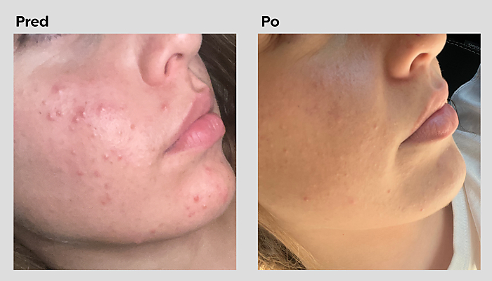 Acne: what causes it and what really helps