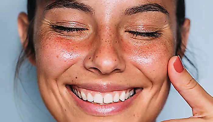 Rosacea: phenotypes, triggers and skincare