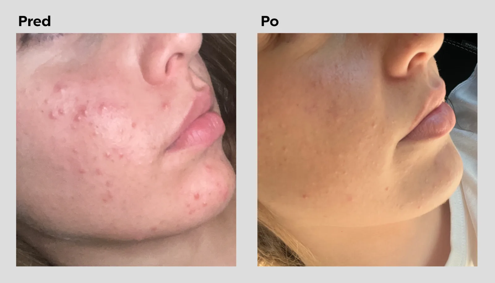 Acne before and after